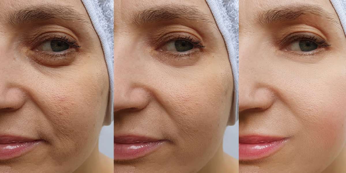 Blefaroplastia Antes E Depois Transforma Es Vis Veis E Naturais