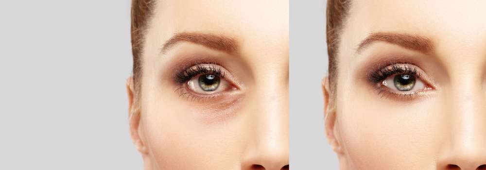 Blefaroplastia Sem Cortes Rejuvenes A Seus Olhos Sem Cirurgia Cidade Viva